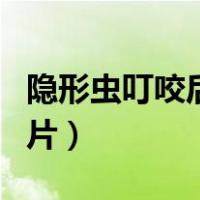 隐形虫叮咬后的症状图（隐形虫叮咬后症状图片）